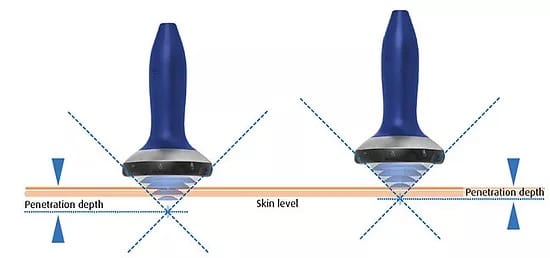 Comparison of ultrasound vibration and PiezoWave2 acoustic compression