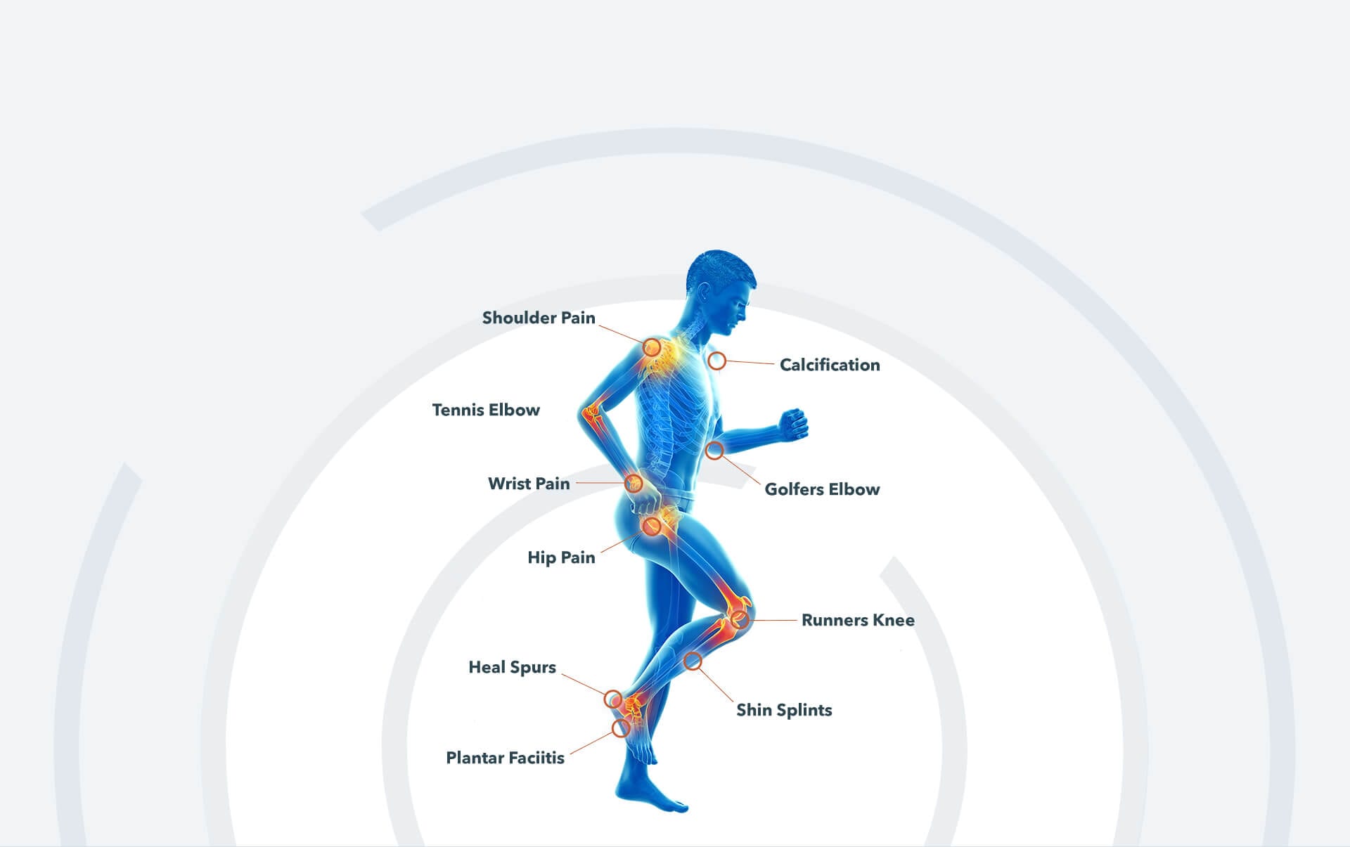 Diagram of the body showing the conditions shockwave therapy treats