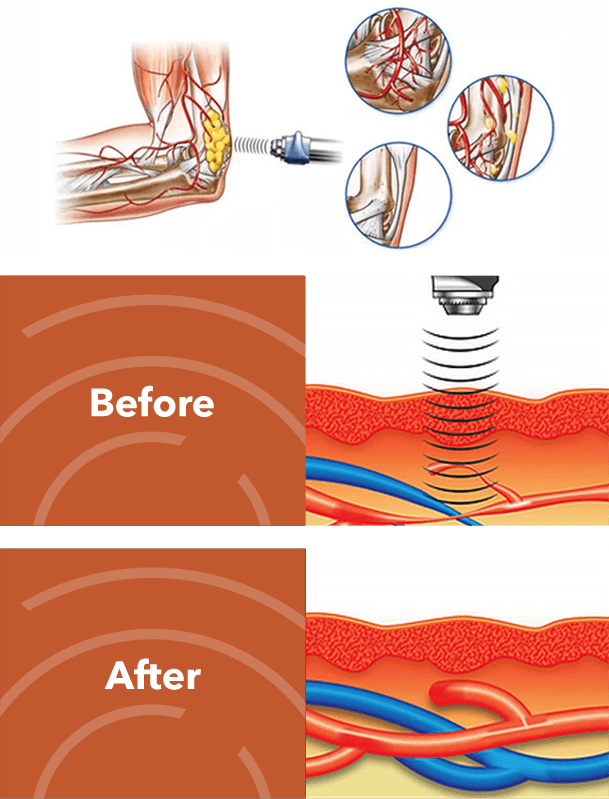 EPAT shockwave therapy system